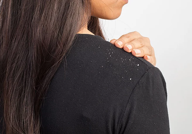 Pre koho ve vhodný Nizoral®?